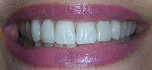 Porcelain Veneers results at Barataria Dental