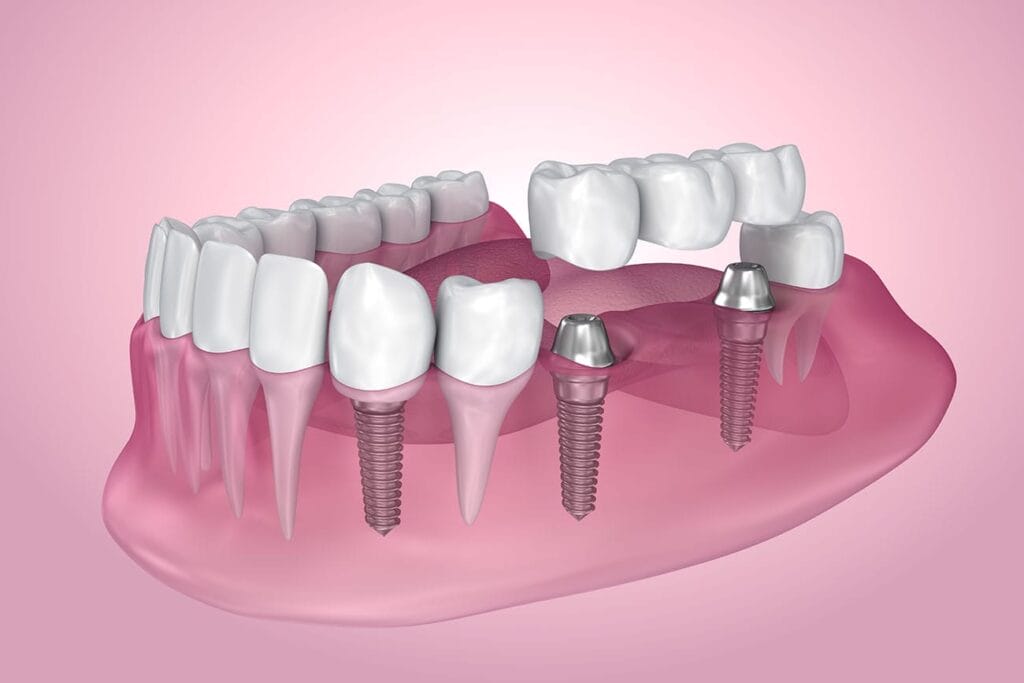 dental implants marrero la
