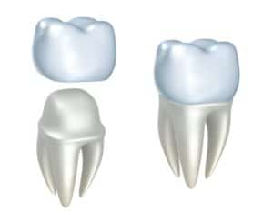 dental crown treatment Marrero Louisiana