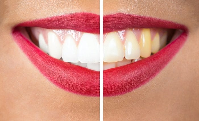 Addressing Different Dental Stains