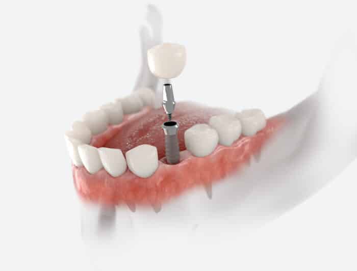 Dental implants offer numerous advantages over traditional tooth replacement options, making them a preferred choice for many patients.