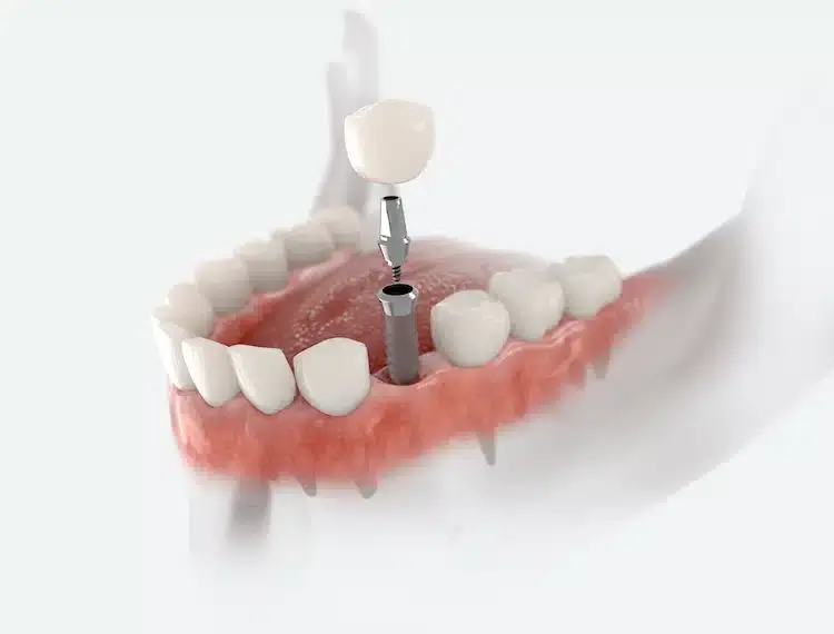 Dental implants offer numerous advantages over traditional tooth replacement options, making them a preferred choice for many patients.